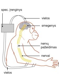 Specialus įrenginys smegenų signalus paverčia elektros impulsais, kurie stimuliuoja raumenis ir priverčia juos susitraukti.